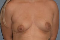 Breast Asymmetry Before & After Gallery - Patient 122327 - Image 1