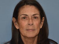 Facial Fat Grafting Before & After Gallery - Patient 102403 - Image 1