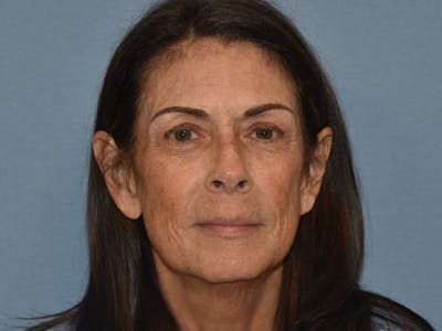 Facial Fat Grafting Before & After Gallery - Patient 102403 - Image 1