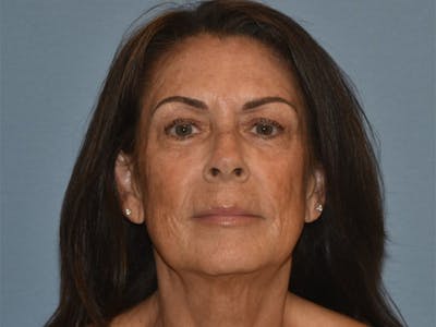 Facial Fat Grafting Before & After Gallery - Patient 102403 - Image 2