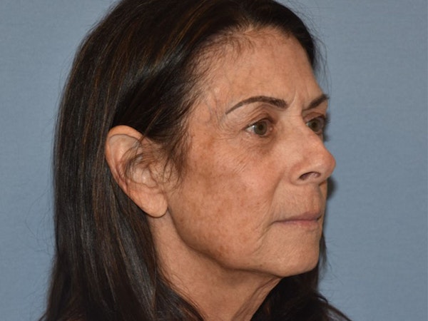 Facial Fat Grafting Before & After Gallery - Patient 102403 - Image 3