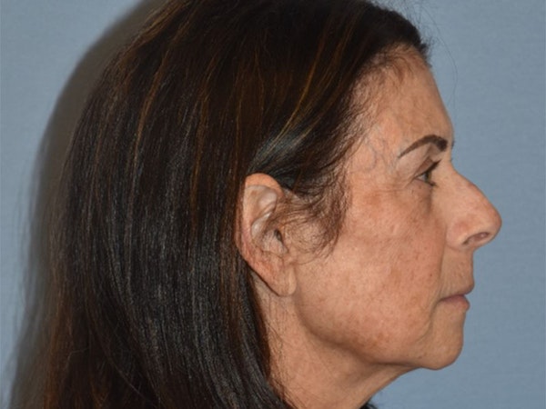 Facial Fat Grafting Before & After Gallery - Patient 102403 - Image 5