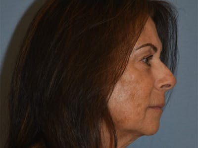 Facial Fat Grafting Before & After Gallery - Patient 102403 - Image 6