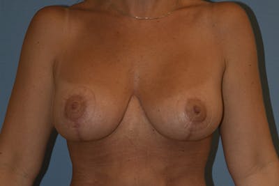 Breast Augmentation Lift Before & After Gallery - Patient 136004 - Image 2