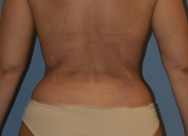 Liposuction Before & After Gallery - Patient 249460 - Image 4