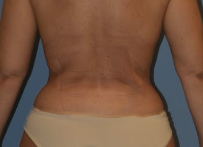 Liposuction Before & After Gallery - Patient 249460 - Image 4