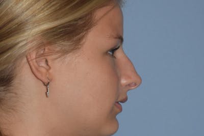 Rhinoplasty Before & After Gallery - Patient 811679 - Image 1