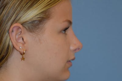 Rhinoplasty Before & After Gallery - Patient 811679 - Image 2