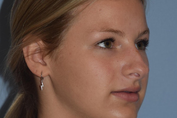 Rhinoplasty Before & After Gallery - Patient 811679 - Image 3