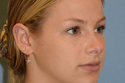 Rhinoplasty Before & After Gallery - Patient 811679 - Image 4