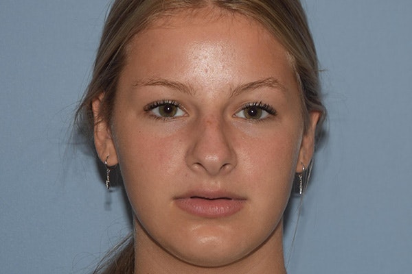 Rhinoplasty Before & After Gallery - Patient 811679 - Image 5