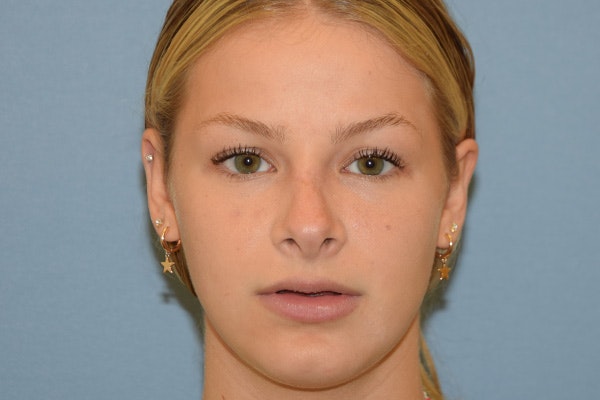 Rhinoplasty Before & After Gallery - Patient 811679 - Image 6