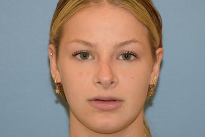 Rhinoplasty Before & After Gallery - Patient 811679 - Image 6