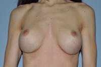 Breast Revision Before & After Gallery - Patient 407990 - Image 1