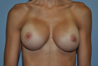 Breast Revision Before & After Gallery - Patient 407990 - Image 2