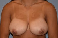 Breast Reduction Before & After Gallery - Patient 390855 - Image 1