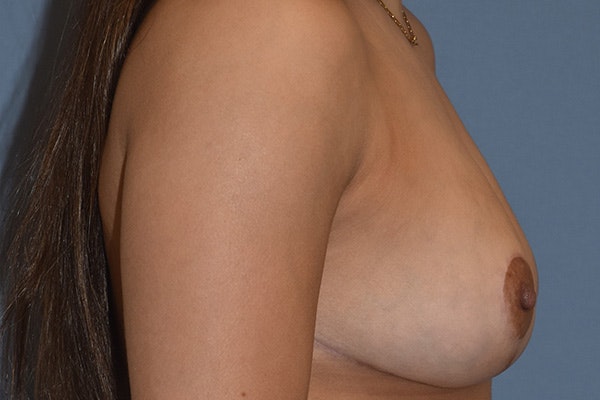 Breast Reduction Before & After Gallery - Patient 390855 - Image 6