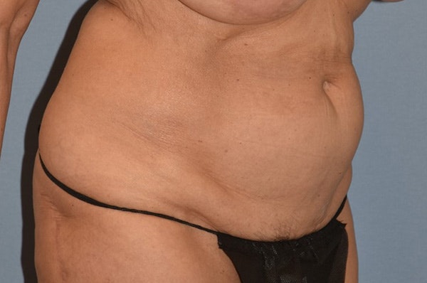 Tummy Tuck Before & After Gallery - Patient 273290 - Image 7