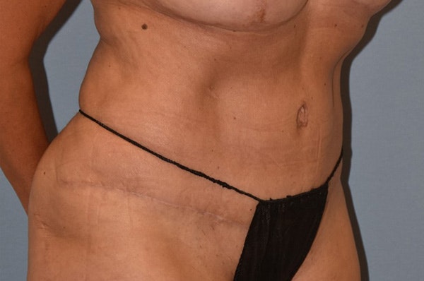 Tummy Tuck Before & After Gallery - Patient 273290 - Image 8
