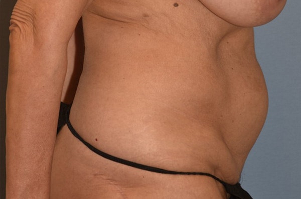 Tummy Tuck Before & After Gallery - Patient 273290 - Image 9