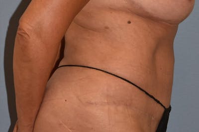 Tummy Tuck Before & After Gallery - Patient 273290 - Image 10