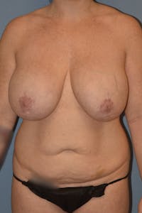 Mommy Makeover Before & After Gallery - Patient 293045 - Image 1