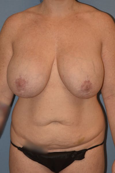 Mommy Makeover Before & After Gallery - Patient 293045 - Image 1