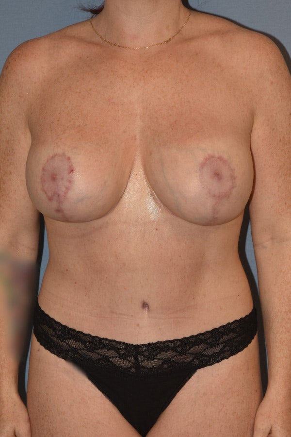 Mommy Makeover Before & After Gallery - Patient 293045 - Image 2