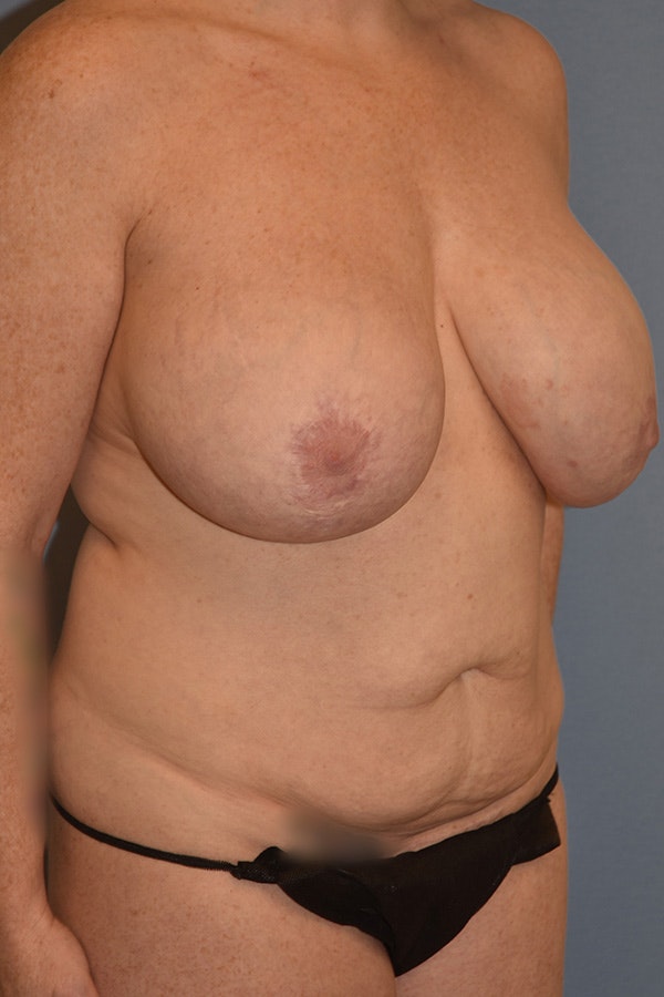 Mommy Makeover Before & After Gallery - Patient 293045 - Image 3