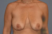 Breast Reduction Before & After Gallery - Patient 236388 - Image 1