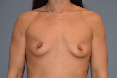 Breast Augmentation Before & After Gallery - Patient 108509 - Image 1