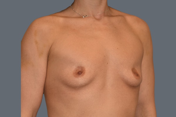 Breast Augmentation Before & After Gallery - Patient 108509 - Image 3