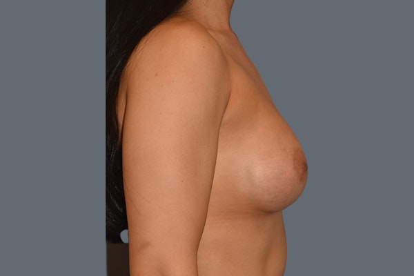Breast Augmentation Before & After Gallery - Patient 108509 - Image 6