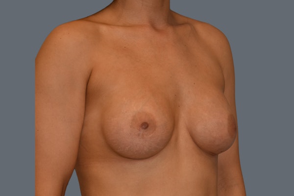 Breast Augmentation Before & After Gallery - Patient 108509 - Image 4