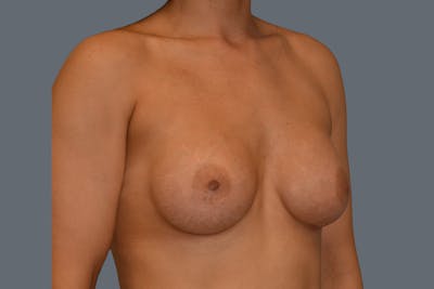 Breast Augmentation Before & After Gallery - Patient 108509 - Image 4