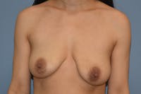 Breast Augmentation Lift Before & After Gallery - Patient 191553 - Image 1