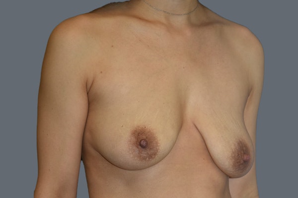 Breast Augmentation Lift Before & After Gallery - Patient 191553 - Image 3