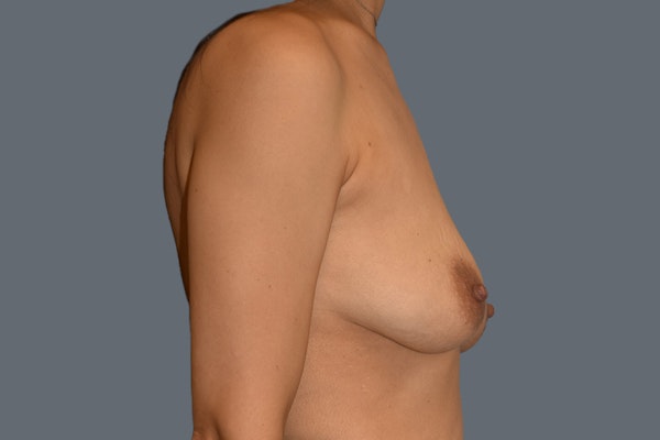 Breast Augmentation Lift Before & After Gallery - Patient 191553 - Image 5
