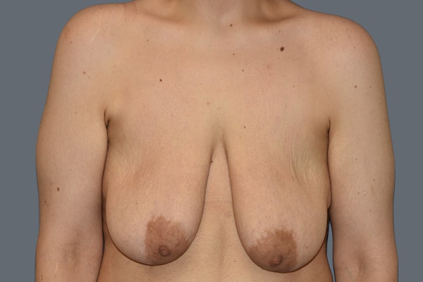Breast Augmentation Lift Before & After Gallery - Patient 568389 - Image 1