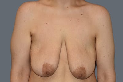 Breast Augmentation Lift Before & After Gallery - Patient 568389 - Image 1