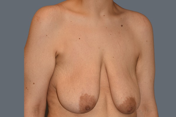 Breast Augmentation Lift Before & After Gallery - Patient 568389 - Image 3