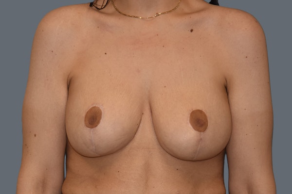 Breast Augmentation Lift Before & After Gallery - Patient 568389 - Image 2