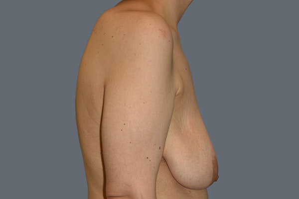 Breast Augmentation Lift Before & After Gallery - Patient 568389 - Image 5
