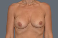 Breast Revision Before & After Gallery - Patient 329990 - Image 1