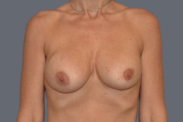 Breast Revision Before & After Gallery - Patient 329990 - Image 1
