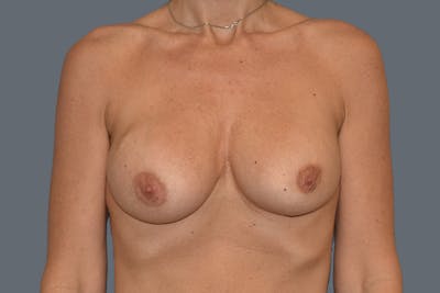 Breast Revision Before & After Gallery - Patient 329990 - Image 1