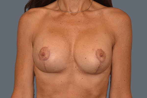 Breast Revision Before & After Gallery - Patient 329990 - Image 2