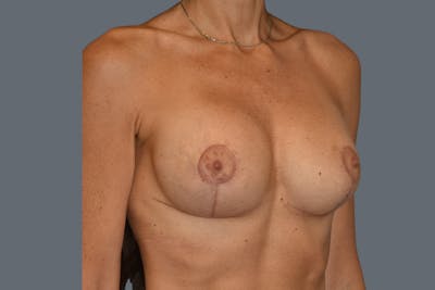 Breast Revision Before & After Gallery - Patient 329990 - Image 4