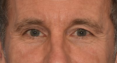 Eyelid Lift Before & After Gallery - Patient 241917 - Image 1