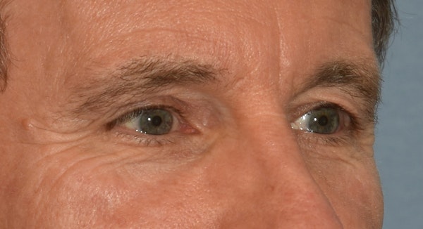 Brow Lift Before & After Gallery - Patient 734324 - Image 3